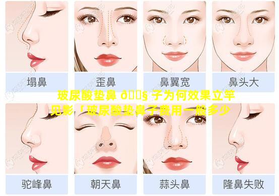 玻尿酸垫鼻 🐧 子为何效果立竿见影「玻尿酸垫鼻子费用一般多少钱 🌼 啊」